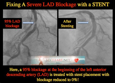 70 Percent Heart Blockage Treatment