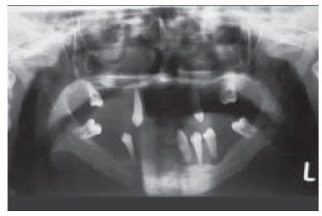 Figure Orthopantomograph Showing Floating In Air Appearance Of