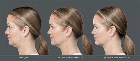 What Is The Best Treatment For Double Chin