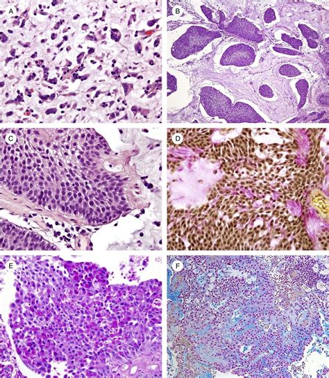 A High Grade Invasive Urothelial Carcinoma Composed Of Individual