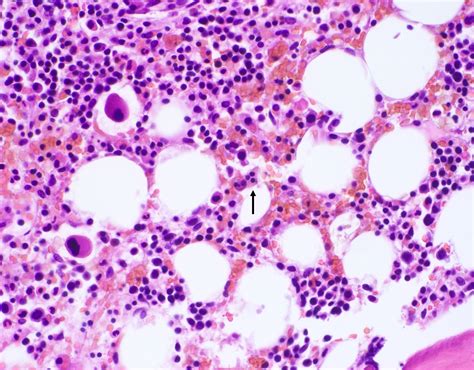 Pathology Outlines Hemophagocytic Lymphohistiocytosis