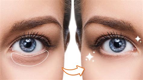 Rf Microneedling For Under Eye Dark Circles How It Works And What To