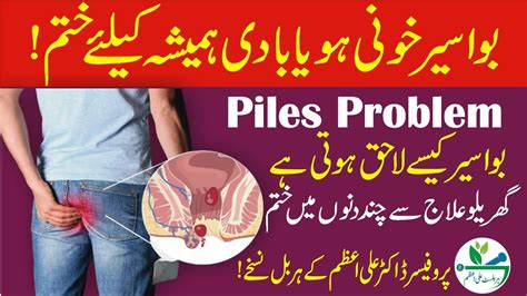 Piles Treatment At Home In Urdu Bawaseer Types Aur Herbal Ilaj By