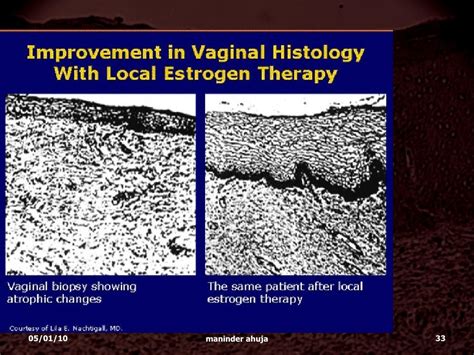 Atrophic Vaginitis Under Treated Under Diagnosed F