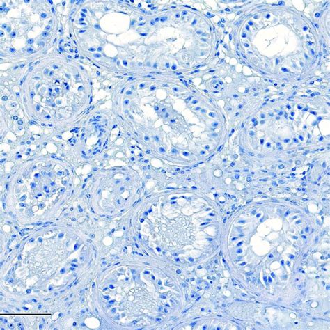 Sertoli Only Cells Syndrome Most Of The Tubules Can Be Found With A