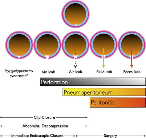 Endoscopic Management Of Colonoscopic Perforations With Videos Gastrointestinal Endoscopy