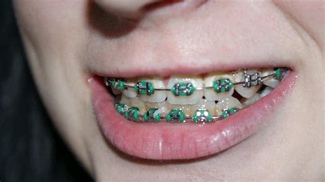 Accelerated Orthodontics In Toronto Procedure Cost And Advantages