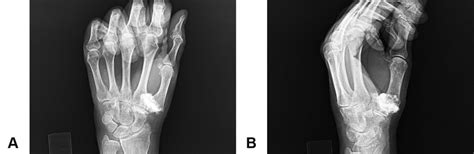 Example of an intra-articular injection, with contrast material within ...