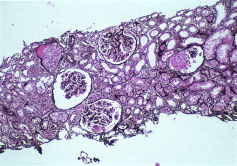 Ajkd Atlas Of Renal Pathology Antiglomerular Basement Membrane Antibodymediated