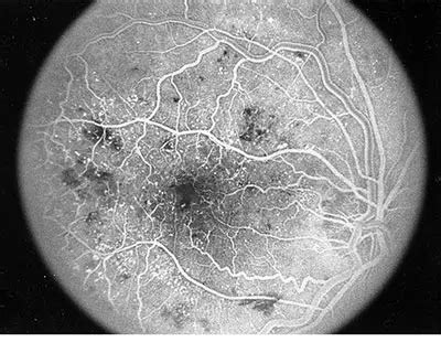 Fluorescein Angiography – Retina Orange County