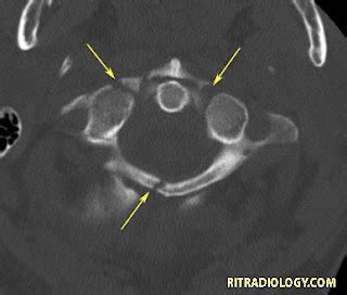 RiT radiology: Jefferson Fracture