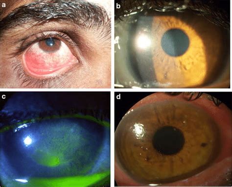 Clinical Picture Showing Proptosis Edema Conjunctival Hyperemia And Images