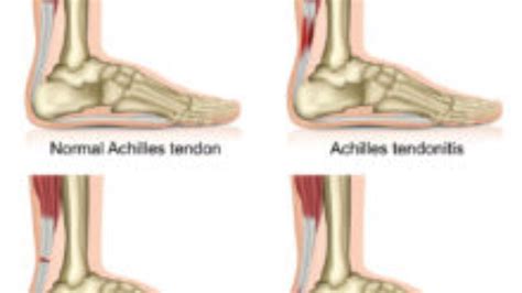 Lump On Back Of Achilles Tendon Atelier Yuwaciaojp