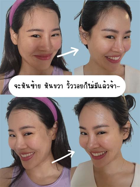 แก้หน้ายับ ด้วย Botox รีวิวโบท็อก Aestox ค่า แกลเลอรีที่โพสต์โดย