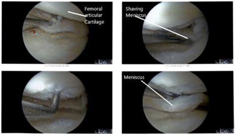 Case Study Chondroplasty Of Left Knee In Yr Old Female