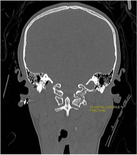 Cervical CT in bone window (coronal view) revealing left occipital... | Download Scientific Diagram