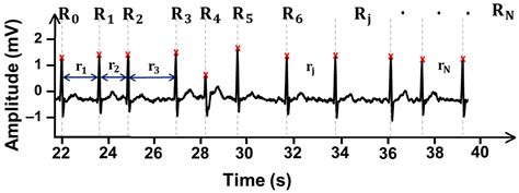 Sensors Free Full Text Automatic Detection Of Atrial Fibrillation In Ecg Using Co Occurrence