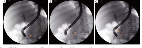 Early Endoscopic Transpapillary Drainage Through The Minor Papilla In