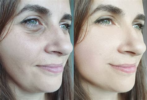 Woman Face Wrinkles Before And After Hydrating Treatment Stock Photo