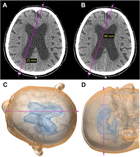 Frontiers Reconsidering Ventriculoperitoneal Shunt Surgery And