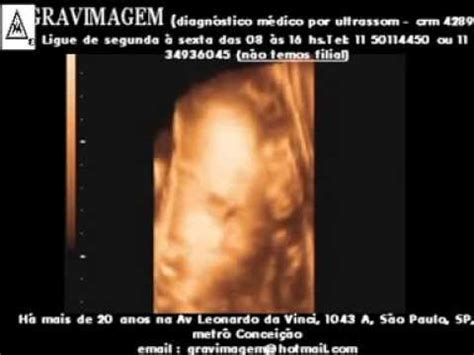 GRAVIMAGEM 14412 ultra som morfológico 3D 4D em gravidez 30 semanas