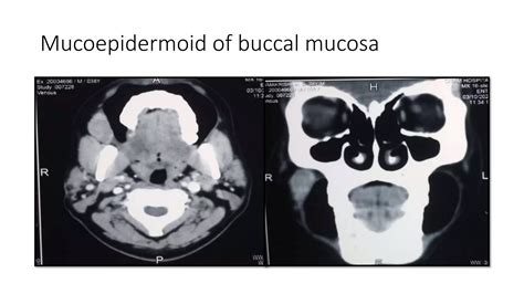 Normal Anatomy Of Buccal Mucosa And Cancer Ppt