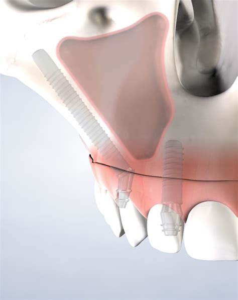 Zygomatic Implants in Feasterville, Newtown, and Abington, PA