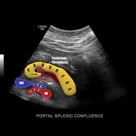 Portal Vein Doppler Artofit