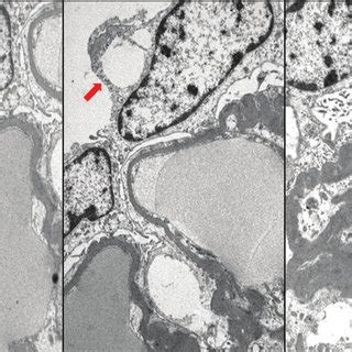 Patient 2 Electron Microscopy Showing Podocyte Foot Process Effacement