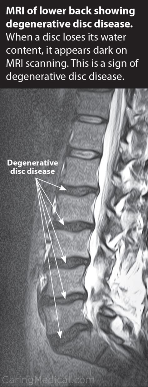 Mri Images Spine