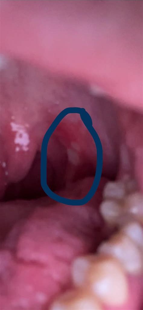 canker sore on tonsil : r/CankerSores