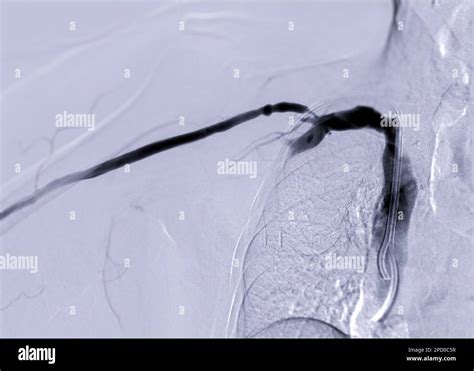 Image Of Angioplasty Balloon Angioplasty And Percutaneous Transluminal