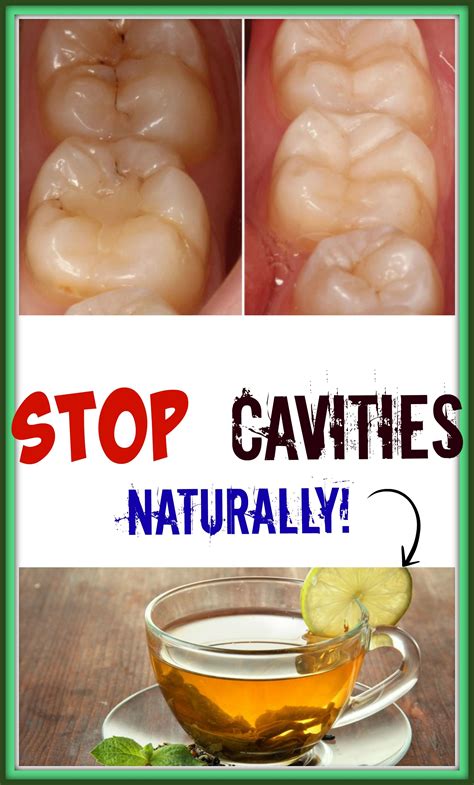 Stop Cavities Naturally Teeth Health Cavities Beauty Health