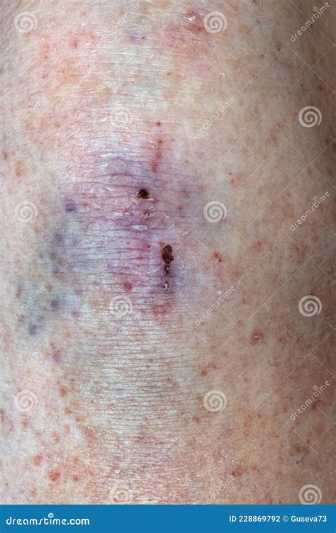 Large Bruise Hematoma On The Humans Leg On The Skin In Different Colors