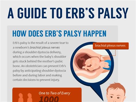 History Of Erbs Palsy Symptoms And Treatment Sample Visualization