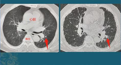 肺腺癌是怎么长出来的？哪种长得快、转移早？腾讯新闻