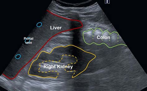 Ultrasound Anatomy Abdomen Abdominal Ultrasound Scan Ultrasound Scan