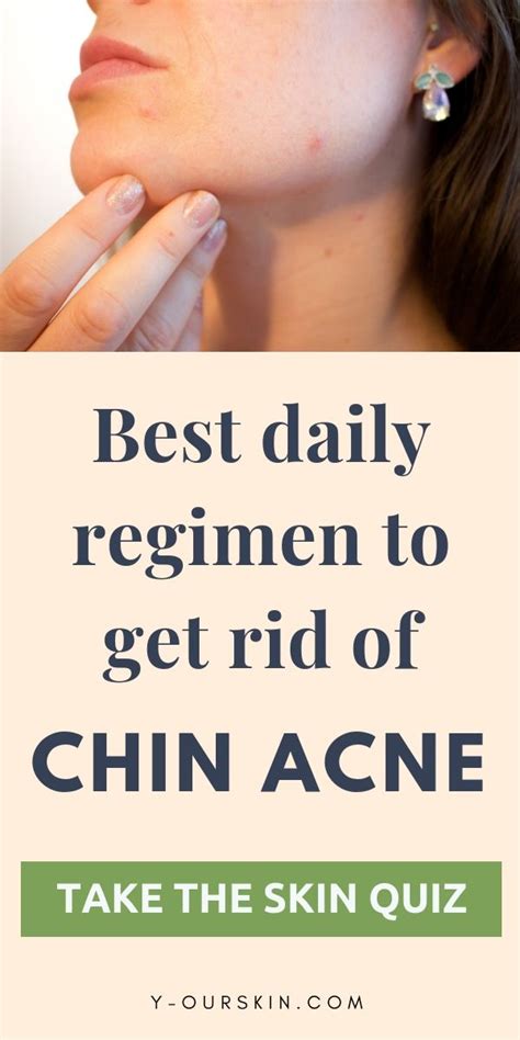 Best Daily Regimen To Get Rid Of Chin Acne Take The Skin Quiz To Get