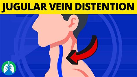 What Is Jugular Venous Distention? (Medical Definition And, 57% OFF