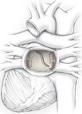 Ask The Doctor Can I Have A Catheter Procedure To Stop Atrial