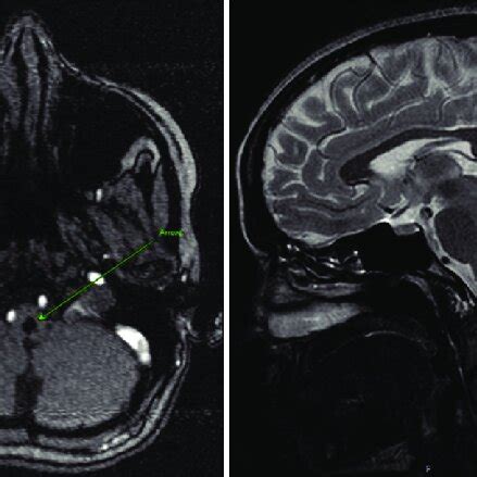 MRI picture showing hypointense medullary cavernoma measuring 8x8x6 mm ...