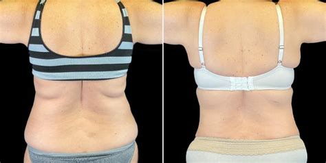 Atlanta Ga Fleur De Lis Tummy Tuck Before And After