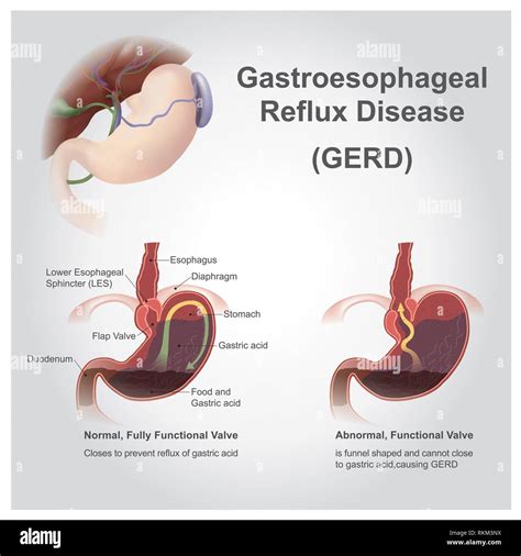 Enfermedad Por Reflujo Gastroesofagico 3d Infografia De Reflujo Acido