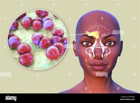 Streptococcus Pneumoniae Bacteria As A Cause Of Sinusitis Computer