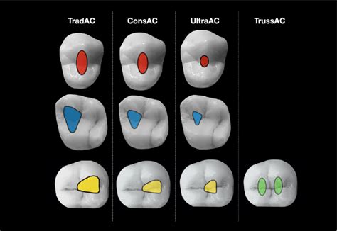 Illustration Of 4 Different Access Cavity Designs Tradac Consac