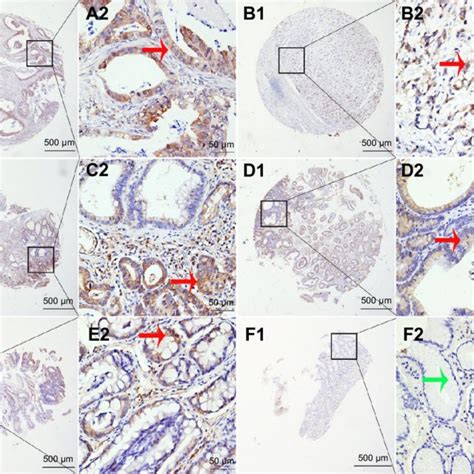 PhgDh Protein Expression In Benign And Malignant Gastric Tissue Samples