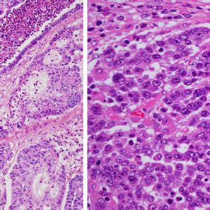 Macroscopic Findings Cut Surface Of The Resected Tumor The Upper Side