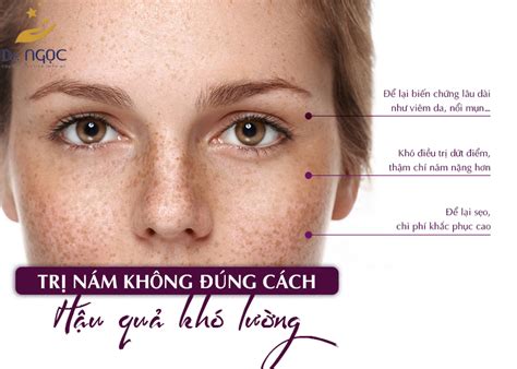 Những Phương Pháp điều Trị Nám Giá Bình Dân Dr Ngọc