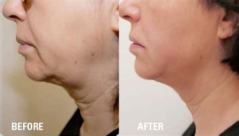 Hifu Before And After For Hifu Facelift Neck And Body