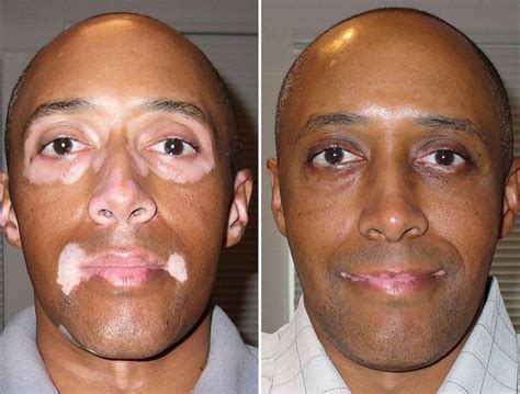 Vitiligo Treatment